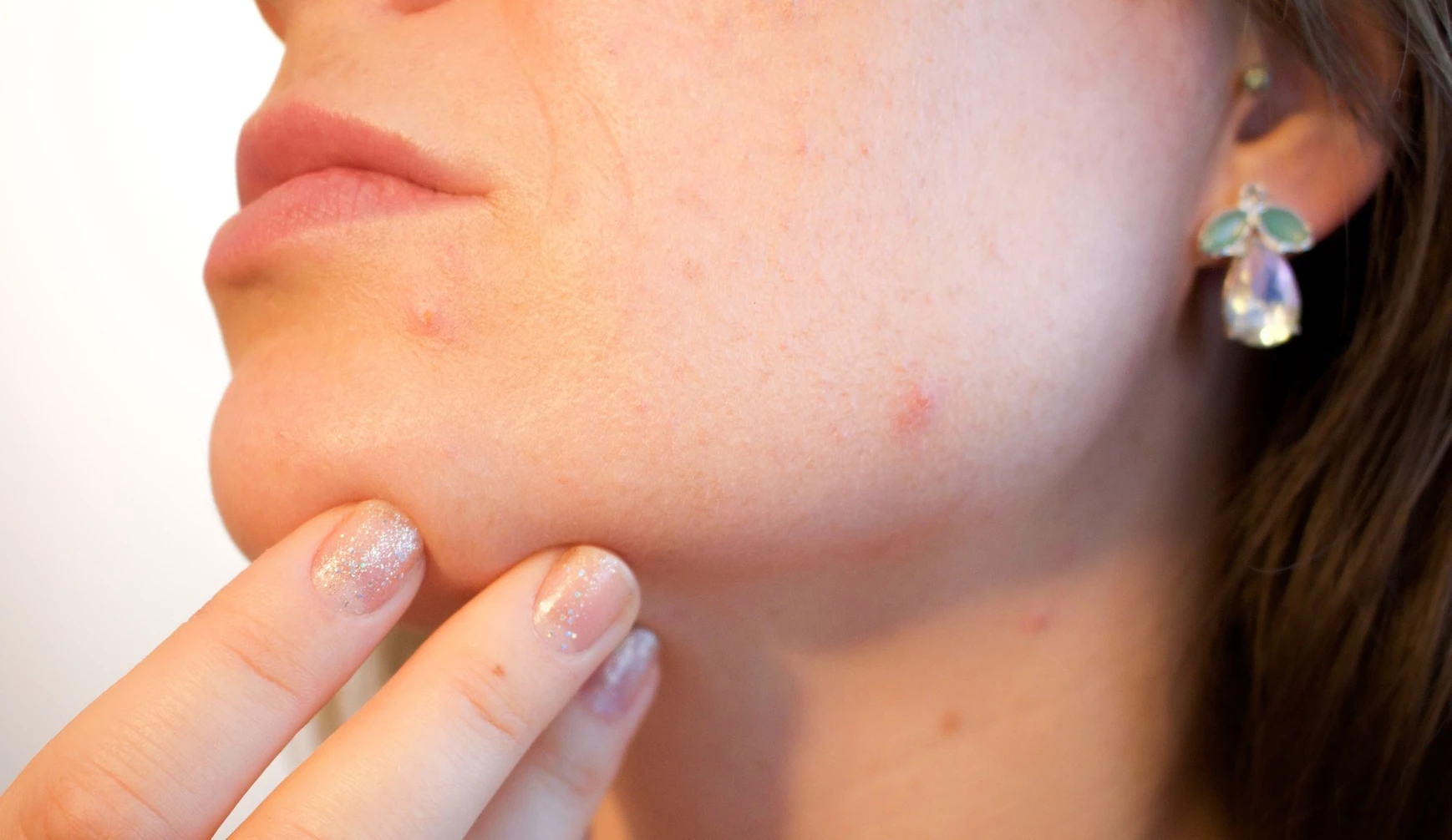 Quelles solutions efficaces pour traiter les peaux à tendance acnéique naturellement